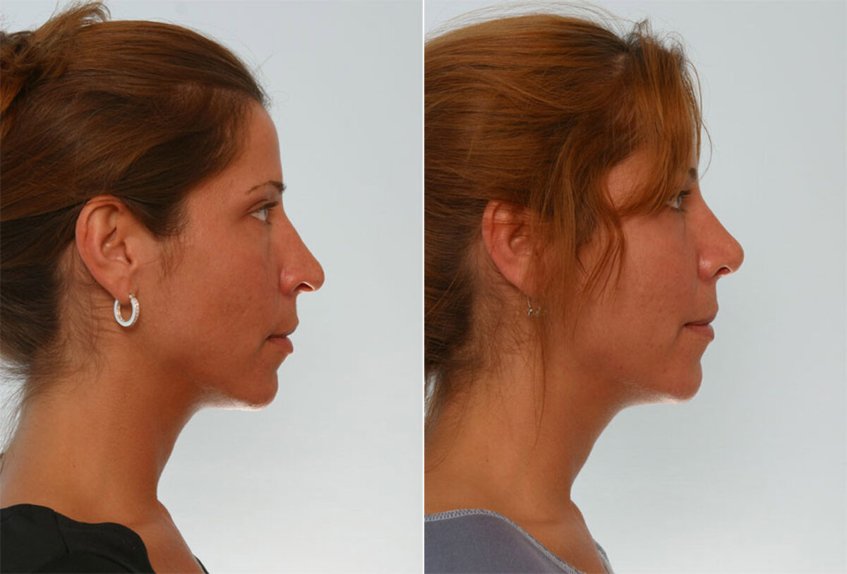 Rhinoplasty before and after photos in Houston, TX, Patient 29583