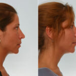 Rhinoplasty before and after photos in Houston, TX, Patient 29583