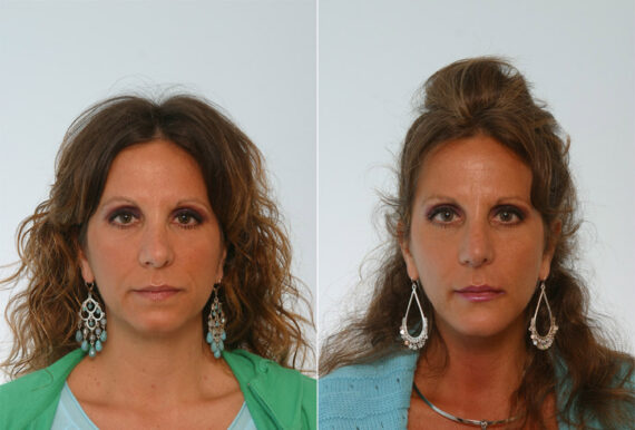 Rhinoplasty before and after photos in Houston, TX, Patient 29590