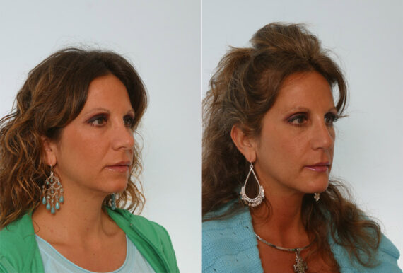 Rhinoplasty before and after photos in Houston, TX, Patient 29590