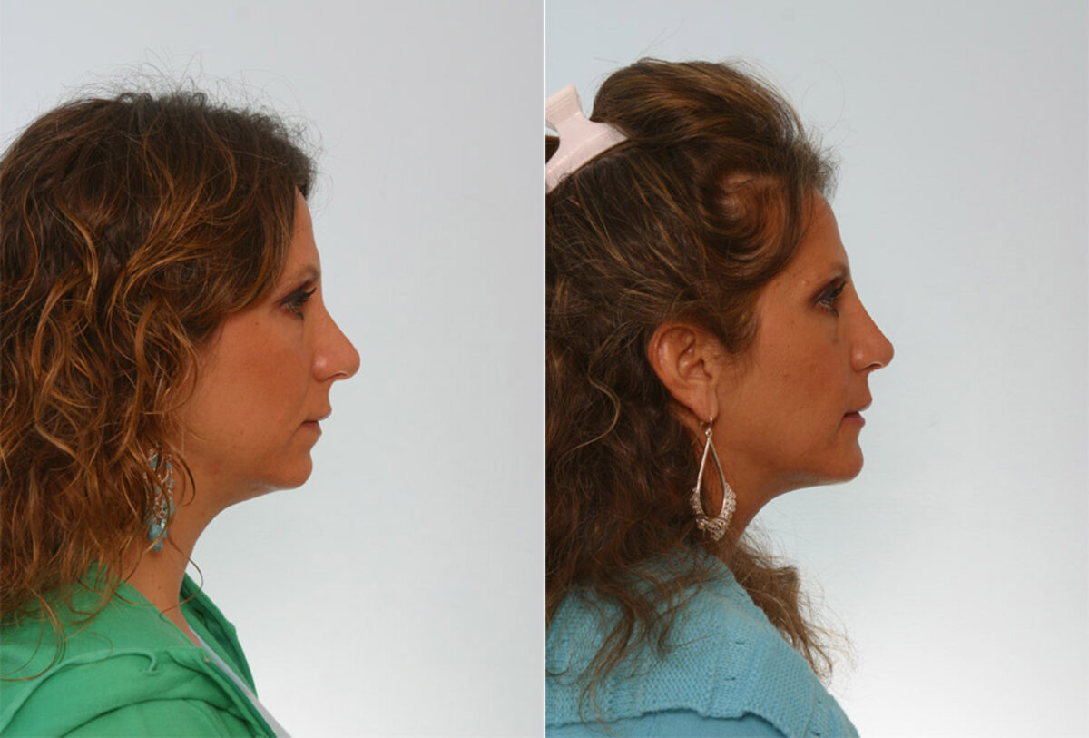 Rhinoplasty before and after photos in Houston, TX, Patient 29590