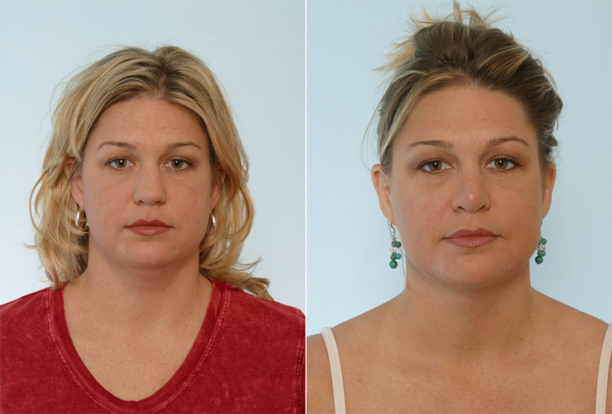 Rhinoplasty before and after photos in Houston, TX, Patient 29597