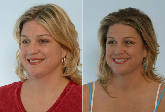Rhinoplasty before and after photos in Houston, TX, Patient 29597
