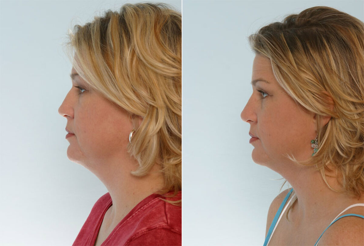 Rhinoplasty before and after photos in Houston, TX, Patient 29597