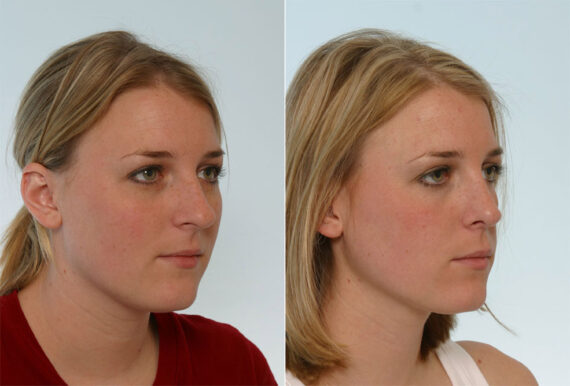 Rhinoplasty before and after photos in Houston, TX, Patient 29604