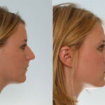 Rhinoplasty before and after photos in Houston, TX, Patient 29604
