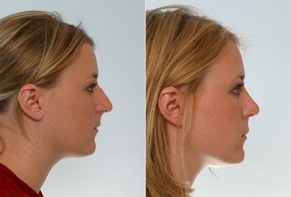 Rhinoplasty before and after photos in Houston, TX, Patient 29604