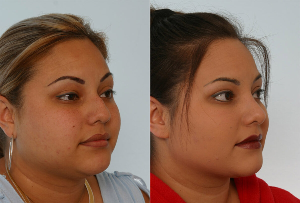 Rhinoplasty before and after photos in Houston, TX, Patient 29611