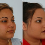 Rhinoplasty before and after photos in Houston, TX, Patient 29611