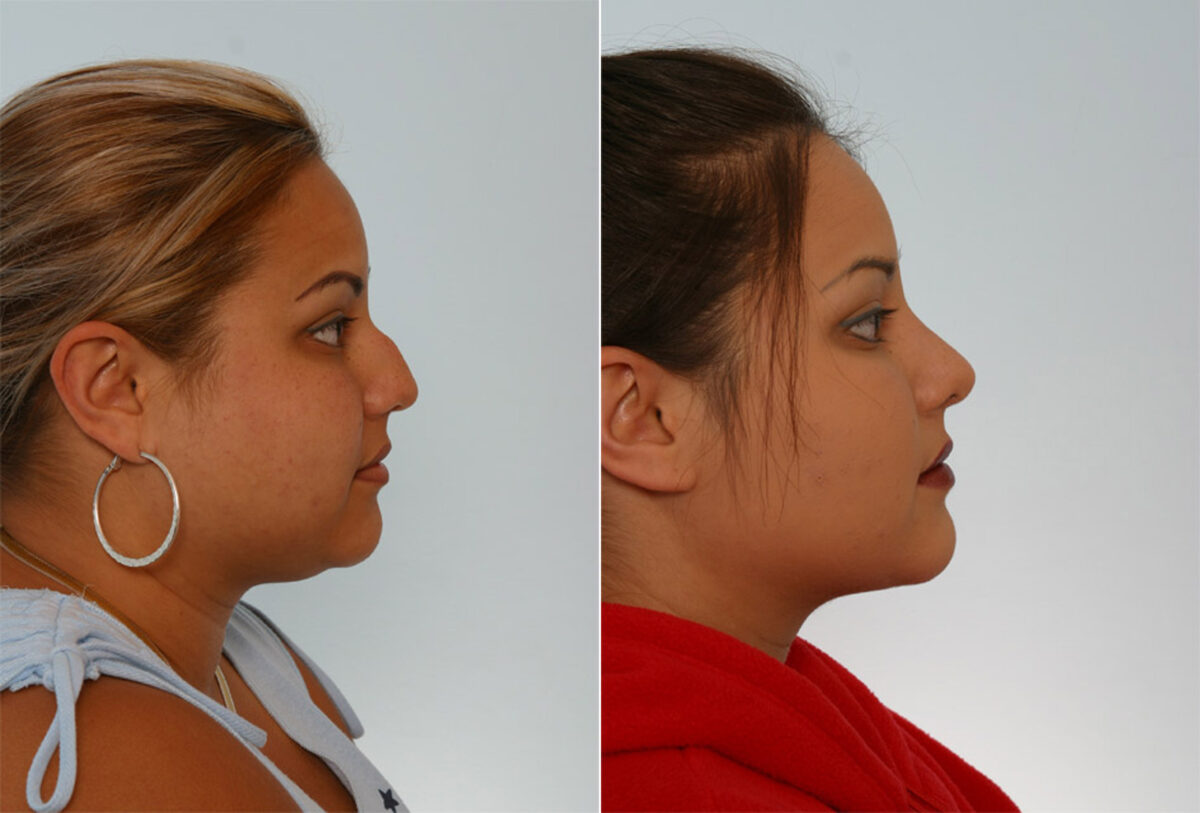 Rhinoplasty before and after photos in Houston, TX, Patient 29611