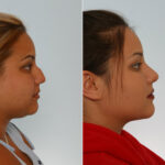 Rhinoplasty before and after photos in Houston, TX, Patient 29611