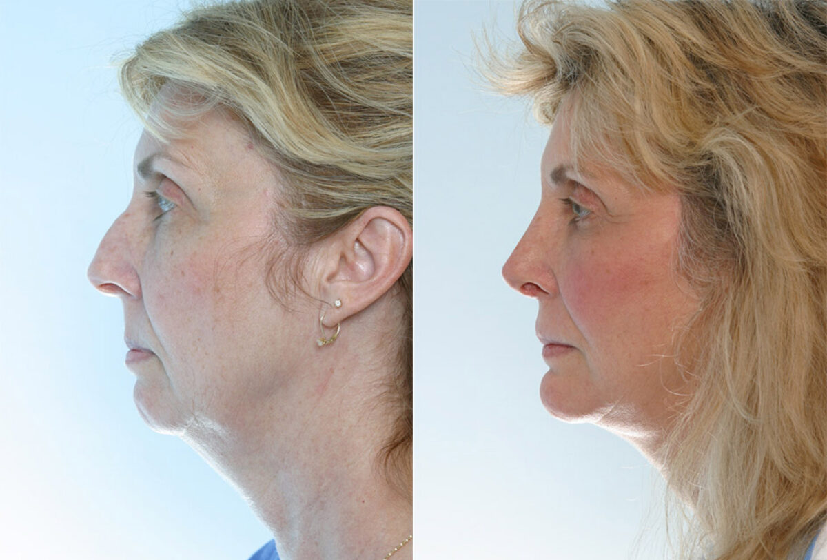 Rhinoplasty before and after photos in Houston, TX, Patient 29618