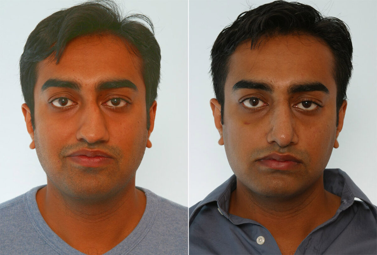 Rhinoplasty before and after photos in Houston, TX, Patient 29625