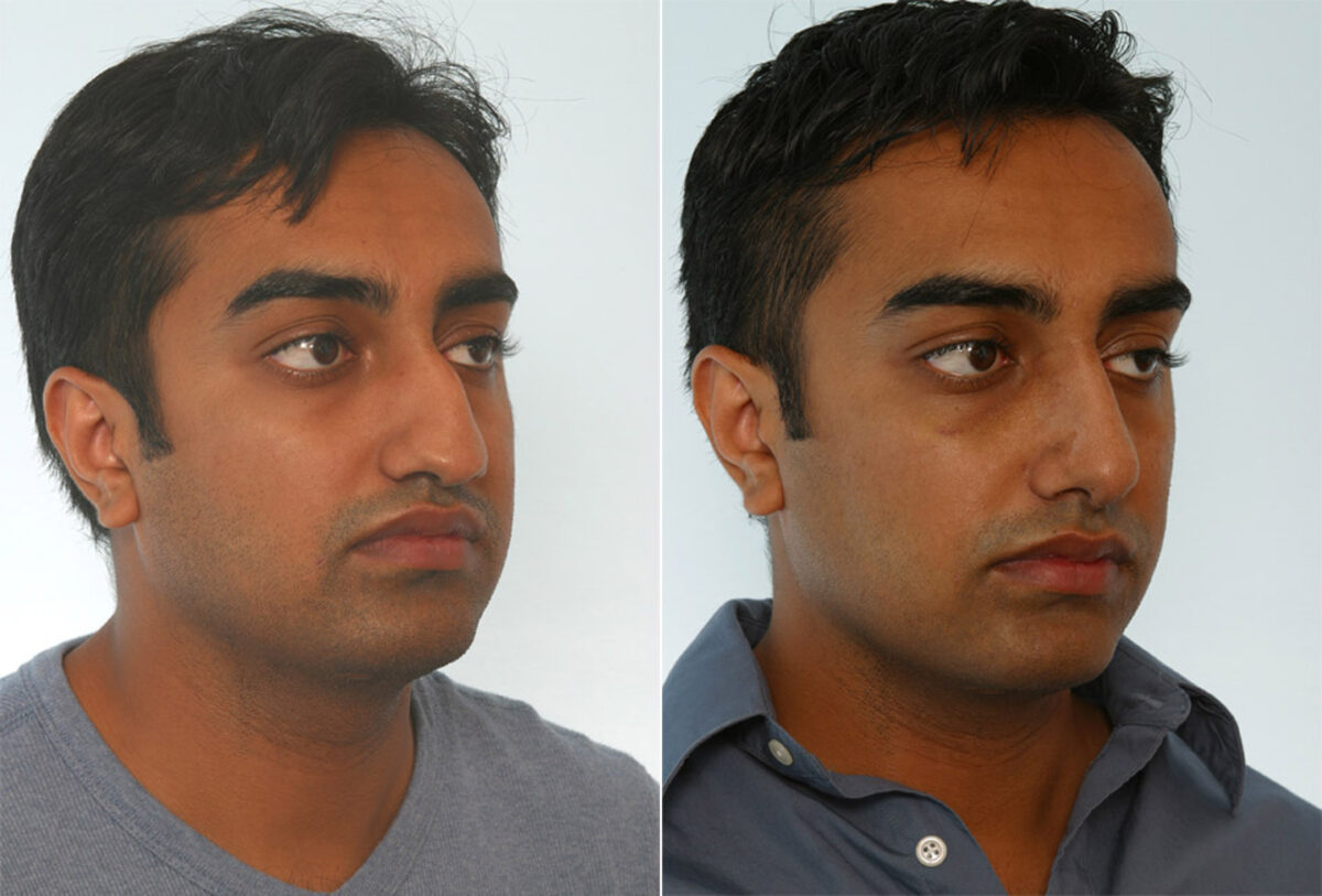 Rhinoplasty before and after photos in Houston, TX, Patient 29625