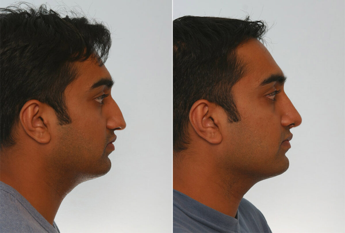 Rhinoplasty before and after photos in Houston, TX, Patient 29625