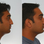 Rhinoplasty before and after photos in Houston, TX, Patient 29625