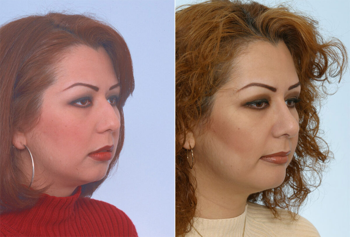 Rhinoplasty before and after photos in Houston, TX, Patient 29632