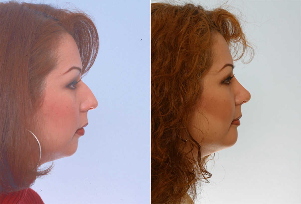 Rhinoplasty before and after photos in Houston, TX, Patient 29632