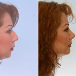 Rhinoplasty before and after photos in Houston, TX, Patient 29632