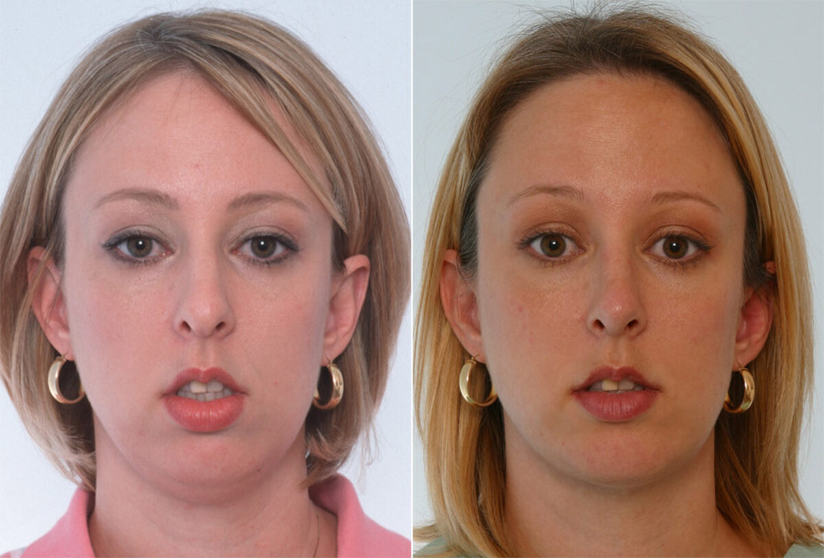 Rhinoplasty before and after photos in Houston, TX, Patient 29639