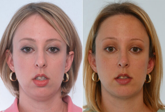 Rhinoplasty before and after photos in Houston, TX, Patient 29639