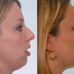 Rhinoplasty before and after photos in Houston, TX, Patient 29639