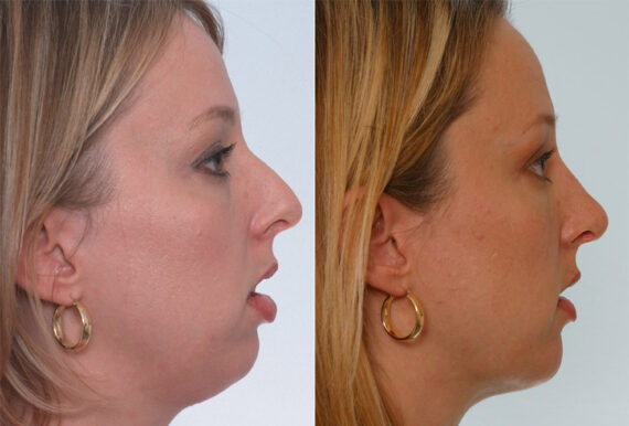 Rhinoplasty before and after photos in Houston, TX, Patient 29639