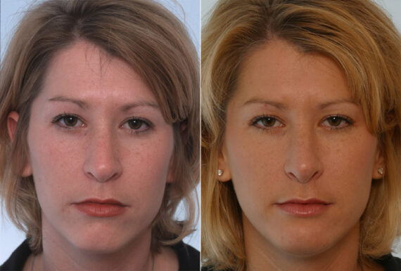 Rhinoplasty before and after photos in Houston, TX, Patient 29644