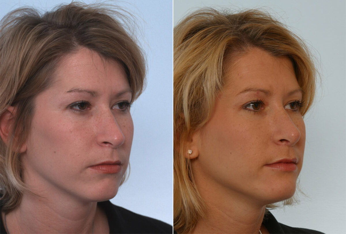Rhinoplasty before and after photos in Houston, TX, Patient 29644