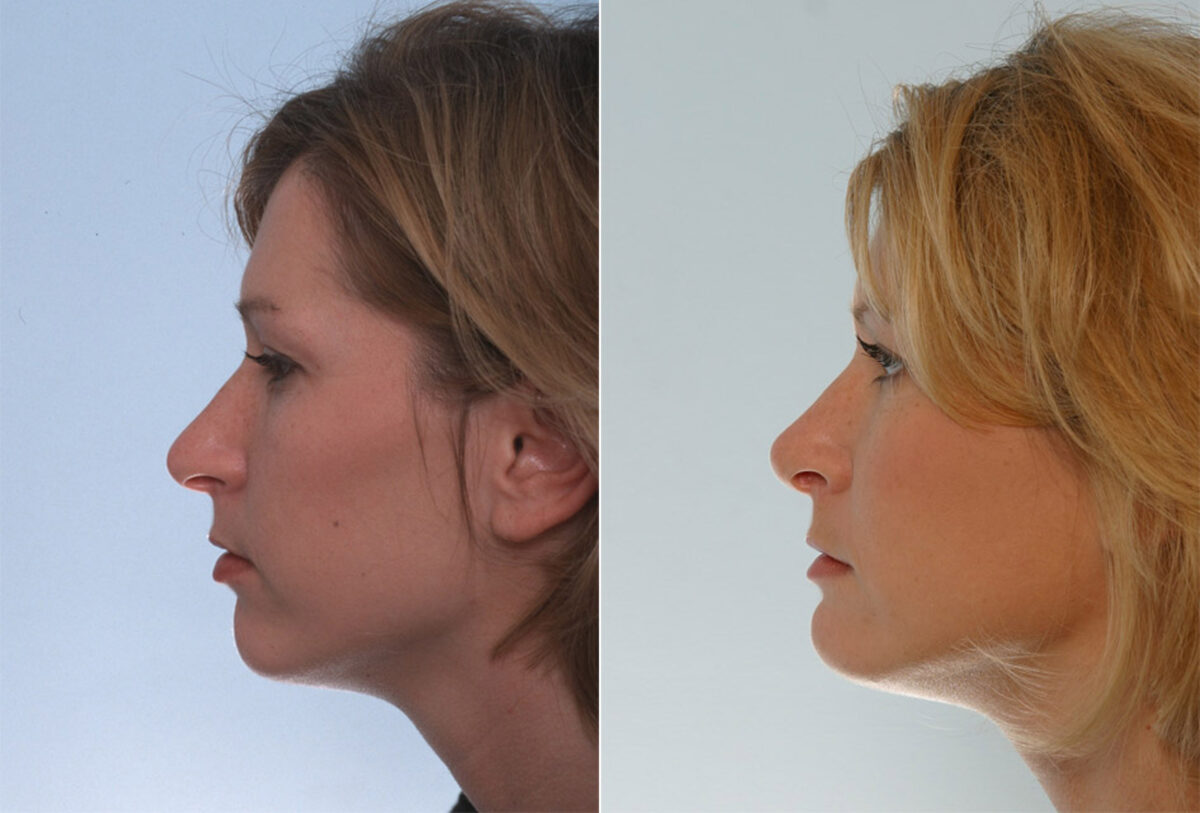 Rhinoplasty before and after photos in Houston, TX, Patient 29644