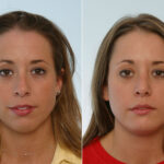 Rhinoplasty before and after photos in Houston, TX, Patient 29651