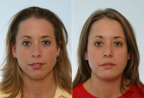 Rhinoplasty before and after photos in Houston, TX, Patient 29651