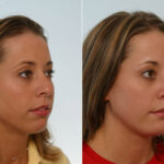 Rhinoplasty before and after photos in Houston, TX, Patient 29651