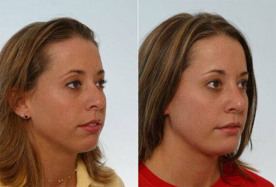 Rhinoplasty before and after photos in Houston, TX, Patient 29651