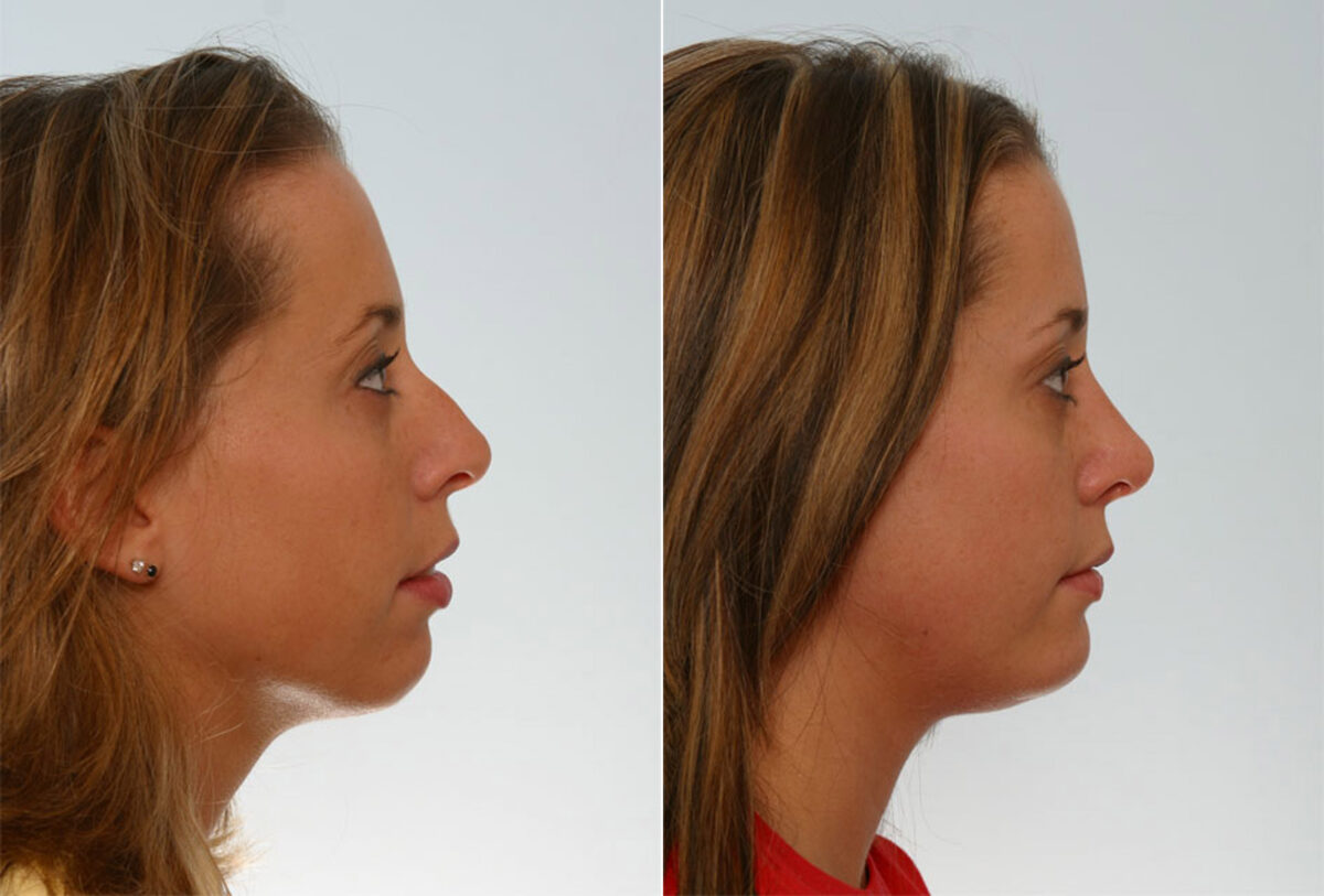 Rhinoplasty before and after photos in Houston, TX, Patient 29651