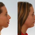 Rhinoplasty before and after photos in Houston, TX, Patient 29651