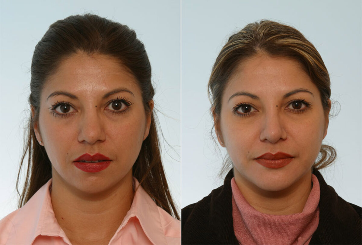 Rhinoplasty before and after photos in Houston, TX, Patient 29658