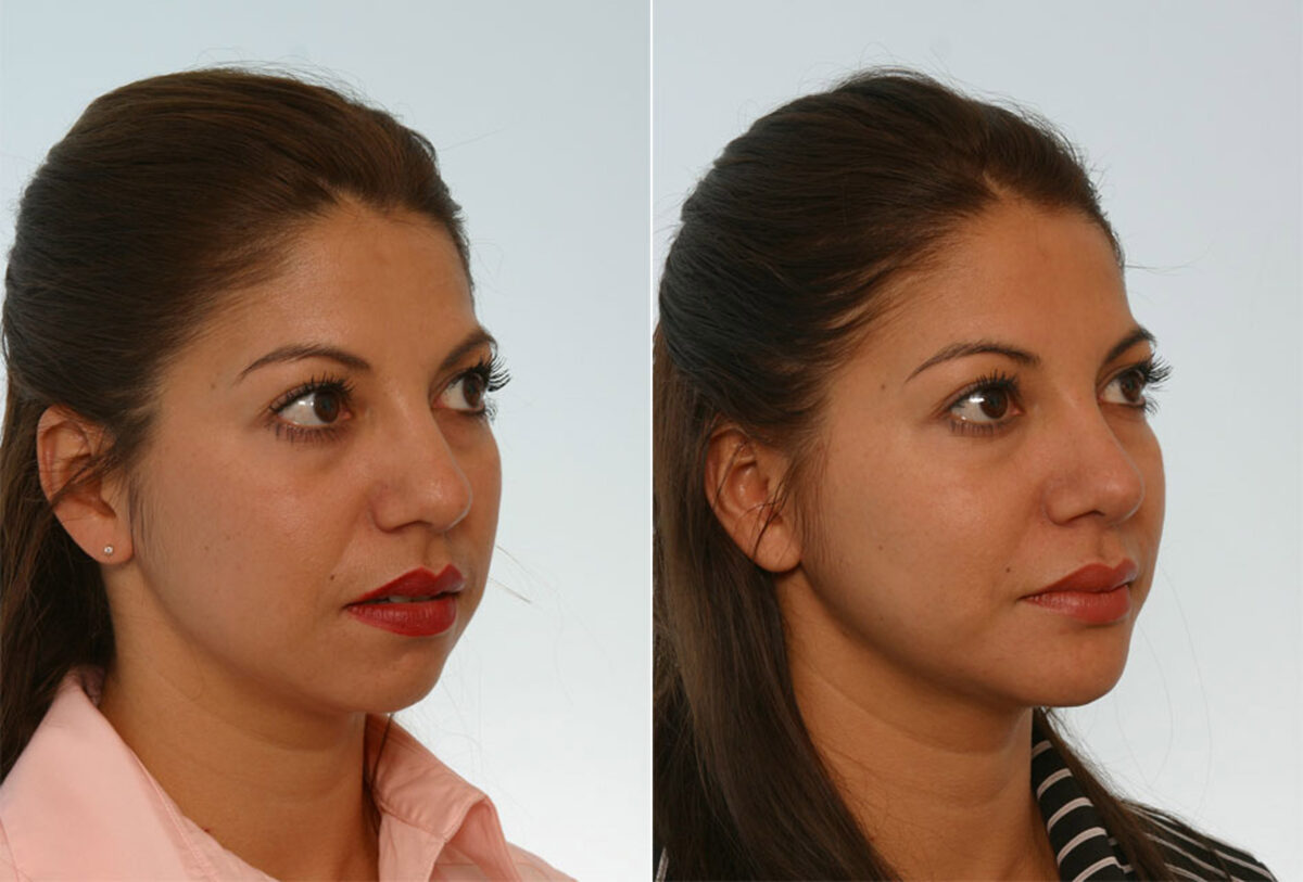 Rhinoplasty before and after photos in Houston, TX, Patient 29658