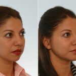 Rhinoplasty before and after photos in Houston, TX, Patient 29658