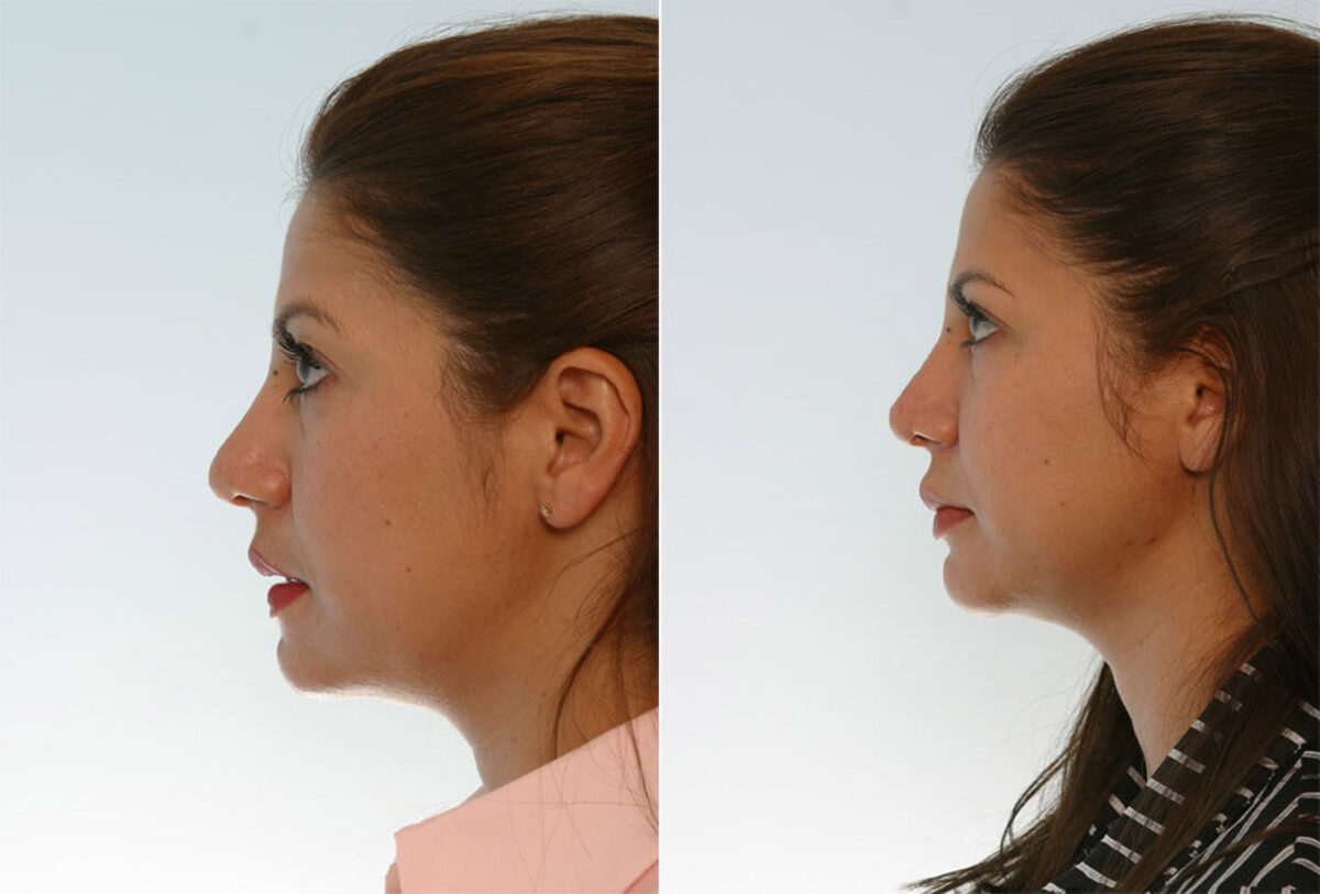 Rhinoplasty before and after photos in Houston, TX, Patient 29658