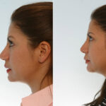 Rhinoplasty before and after photos in Houston, TX, Patient 29658