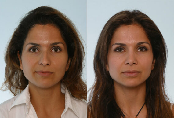 Rhinoplasty before and after photos in Houston, TX, Patient 29665