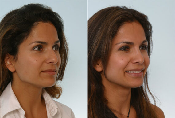 Rhinoplasty before and after photos in Houston, TX, Patient 29665