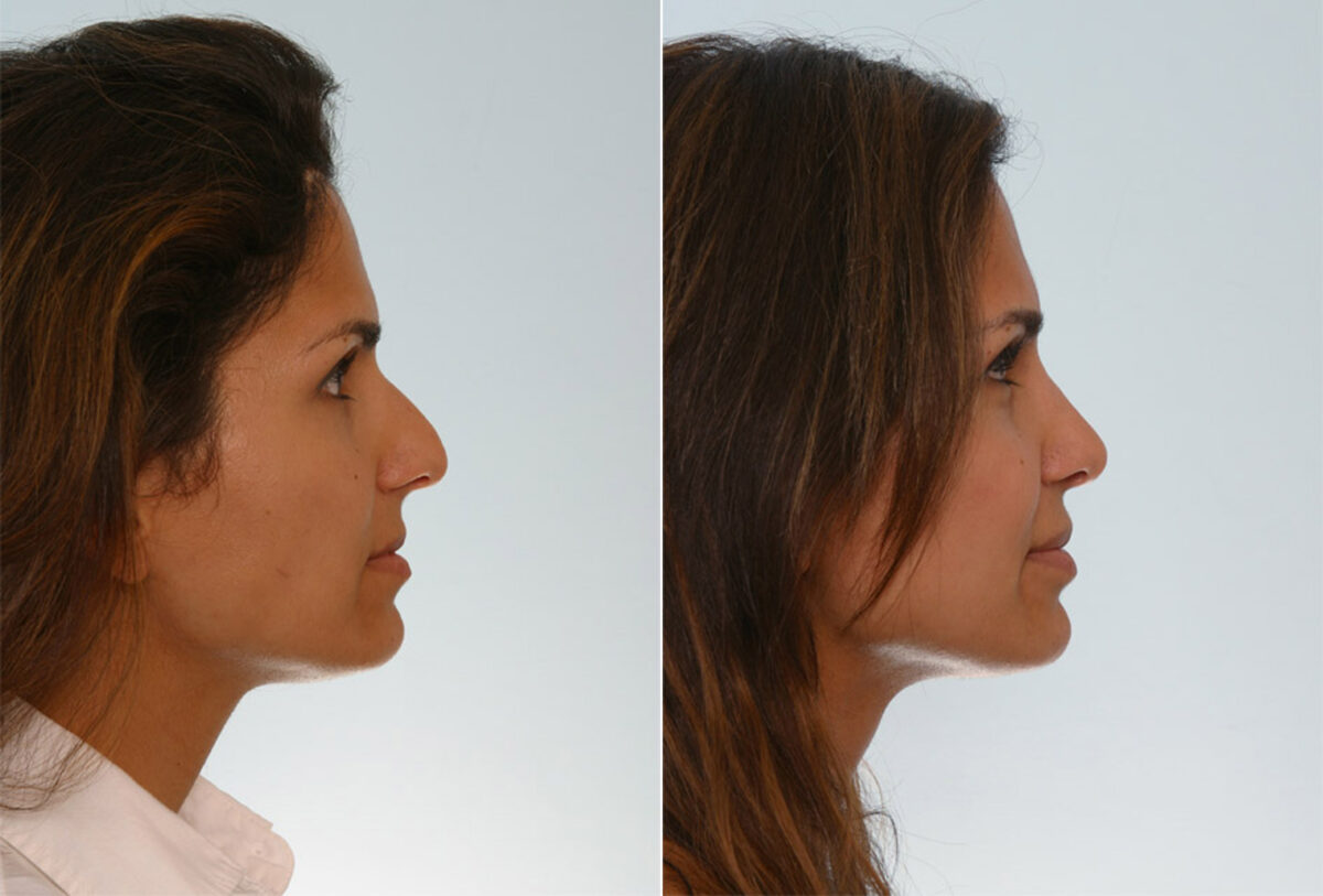 Rhinoplasty before and after photos in Houston, TX, Patient 29665