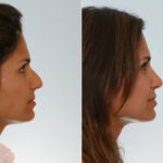 Rhinoplasty before and after photos in Houston, TX, Patient 29665