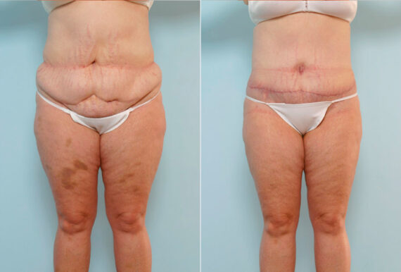 Abdominoplasty before and after photos in Houston, TX, Patient 34630