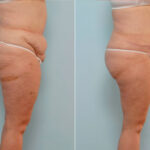 Abdominoplasty before and after photos in Houston, TX, Patient 34630