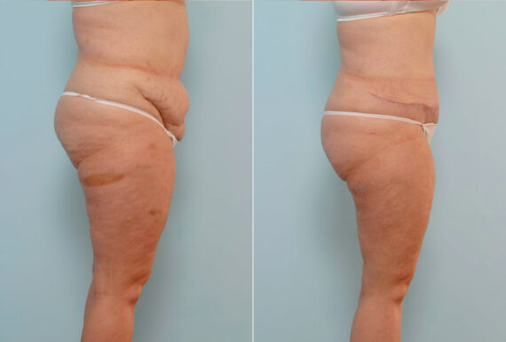 Abdominoplasty before and after photos in Houston, TX, Patient 34630