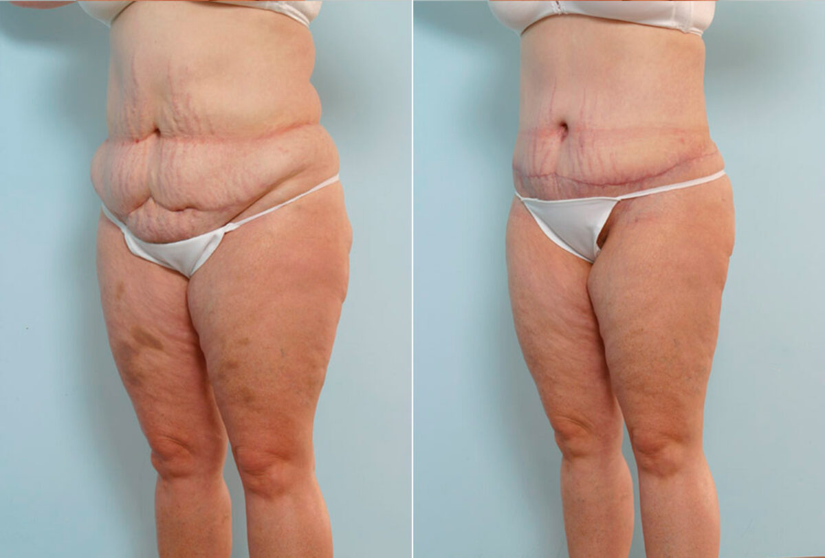 Abdominoplasty before and after photos in Houston, TX, Patient 34630