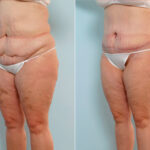 Abdominoplasty before and after photos in Houston, TX, Patient 34630